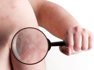 Psoriasis