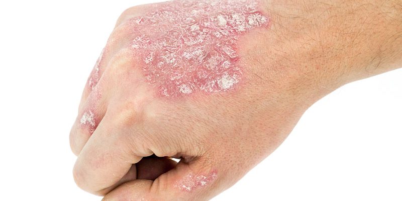 Psoriasis