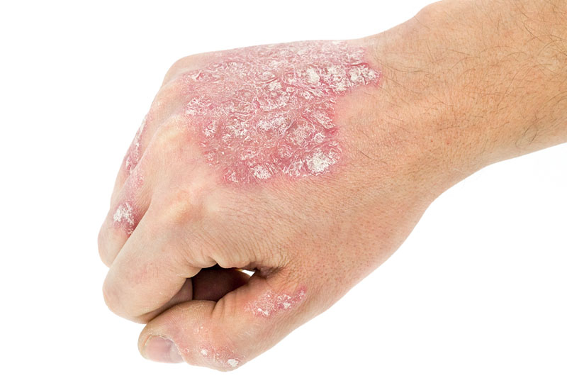 Psoriasis