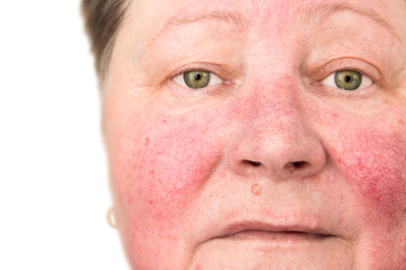 Rosacea