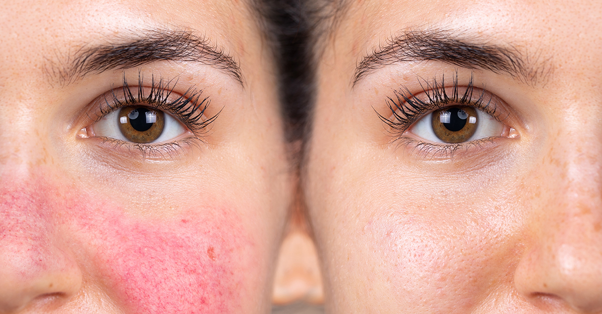 doel pack Aankondiging Last van rosacea? Wat kun je er tegen doen? - SkinEffects