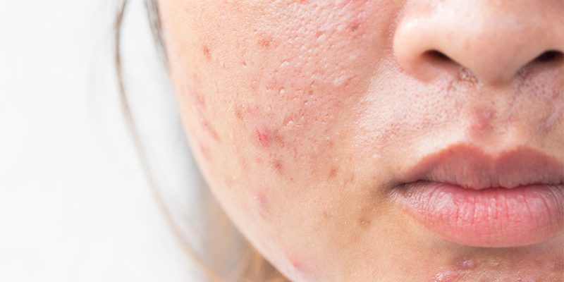 Vulgariteit gemakkelijk Evolueren Acne - SkinEffects