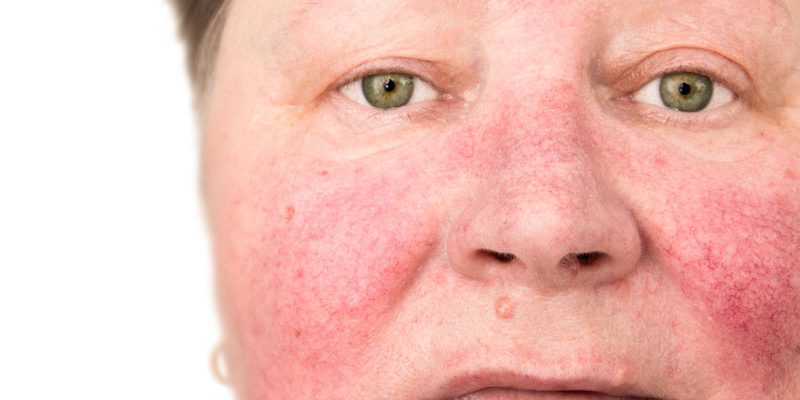 Huidaandoeningen_Rosacea